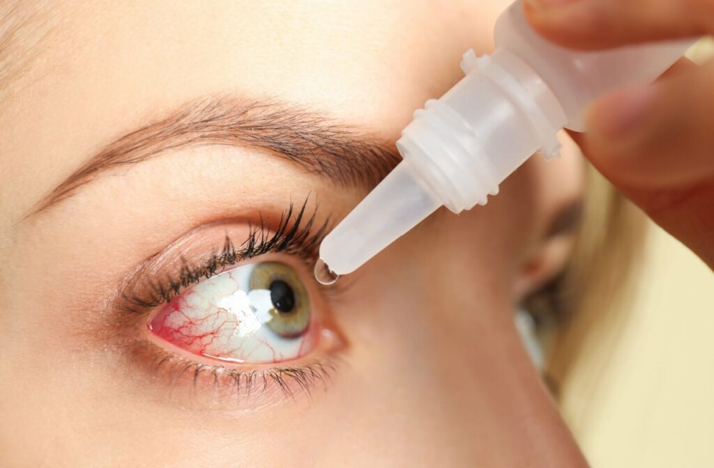 close up to A person uses drops on their dry, red eyes.