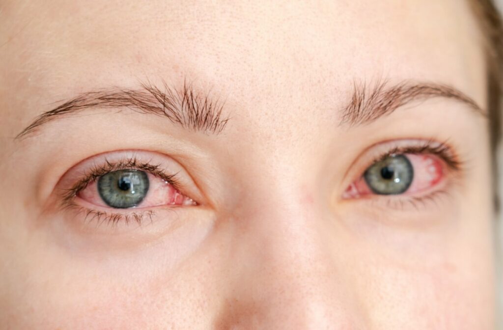 Close-up of a person’s eyes showing redness and irritation, indicative of possible pink eye.