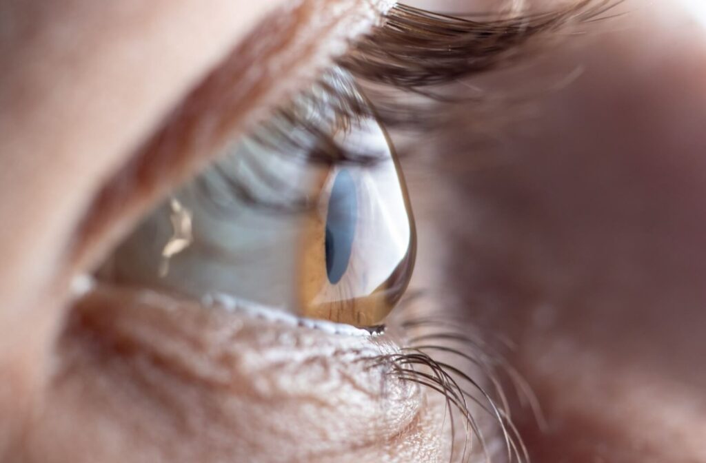 A profile view of the eye is shown, giving a clear look on how a person's eye may be deformed.