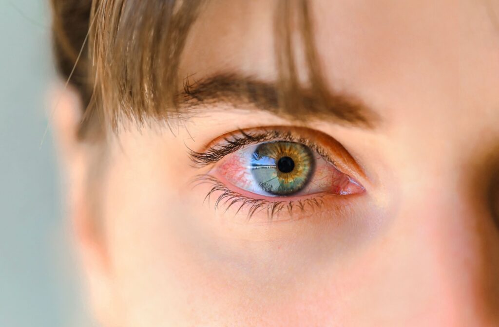 A close up of a red eye caused by irritation to the eye such as blepharitis or conjunctivitis